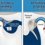 çene eklemi diski kayması, reduksiyonlu reduksiyonsuz nedir