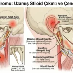 eagle sendromu uzamis stiloid cikinti ve gecmeyen cene alti agrisi