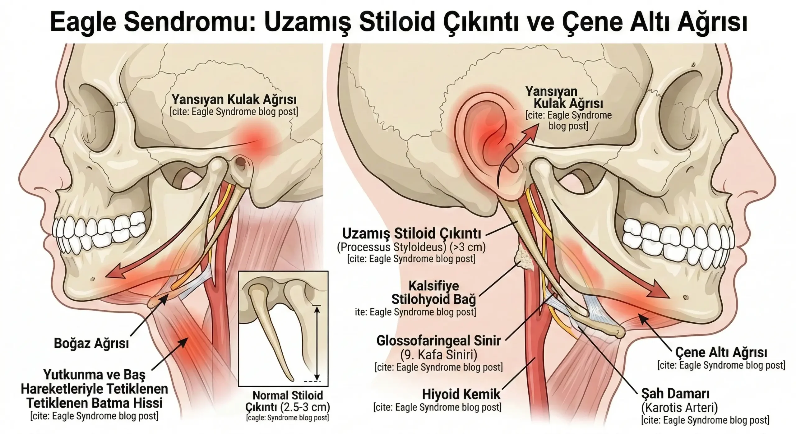 çene çıkması subluksasyon durumunda ilk müdahale ve eklemi koruma yolları