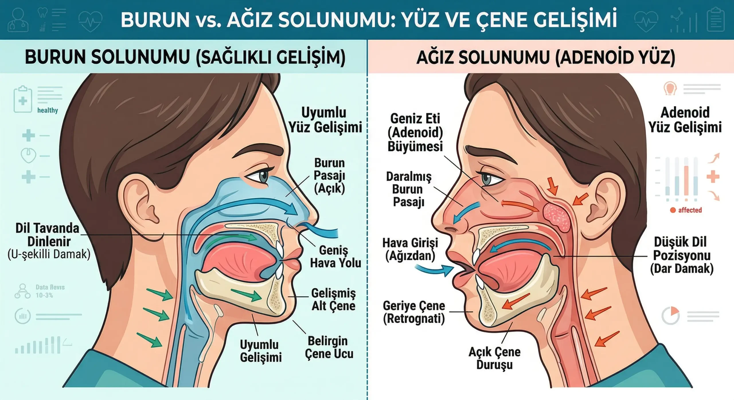 ağız solunumu çeneyi bozar mı
